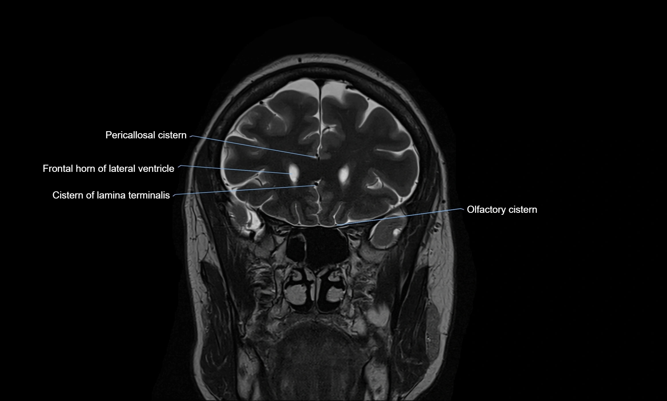 Brain cisterns  and ventricles coronal anatomy 3T MRI image-img-00001-00014.webp
